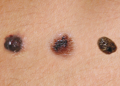 Melanoma, mole or sebaceous wart? | Tidsskrift for Den norske legeforening