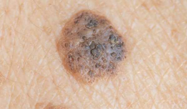 Seborrheic Keratosis vs. Melanoma | Vujevich Dermatology